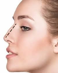 Rhinoplastie Lyon